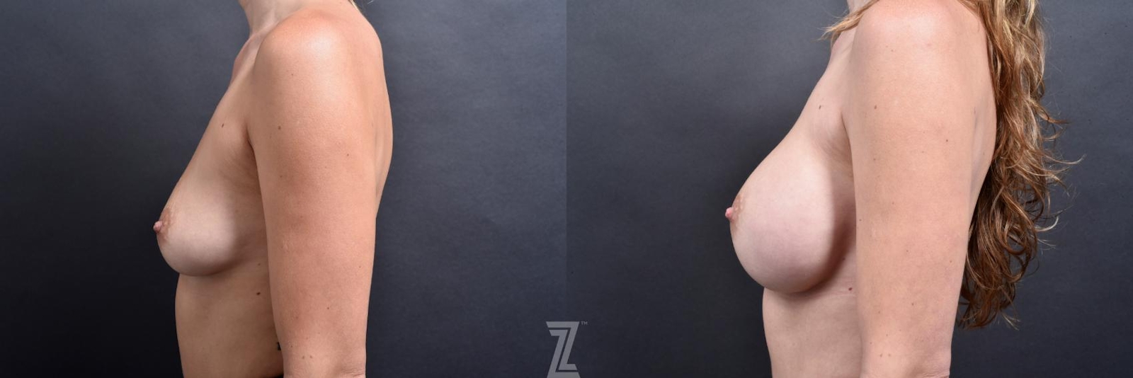 Austin Lateral View before and after 1 year post op 39 year old woman with Silicone Implants with Cohesive Silicone Gel - The Piazza Center