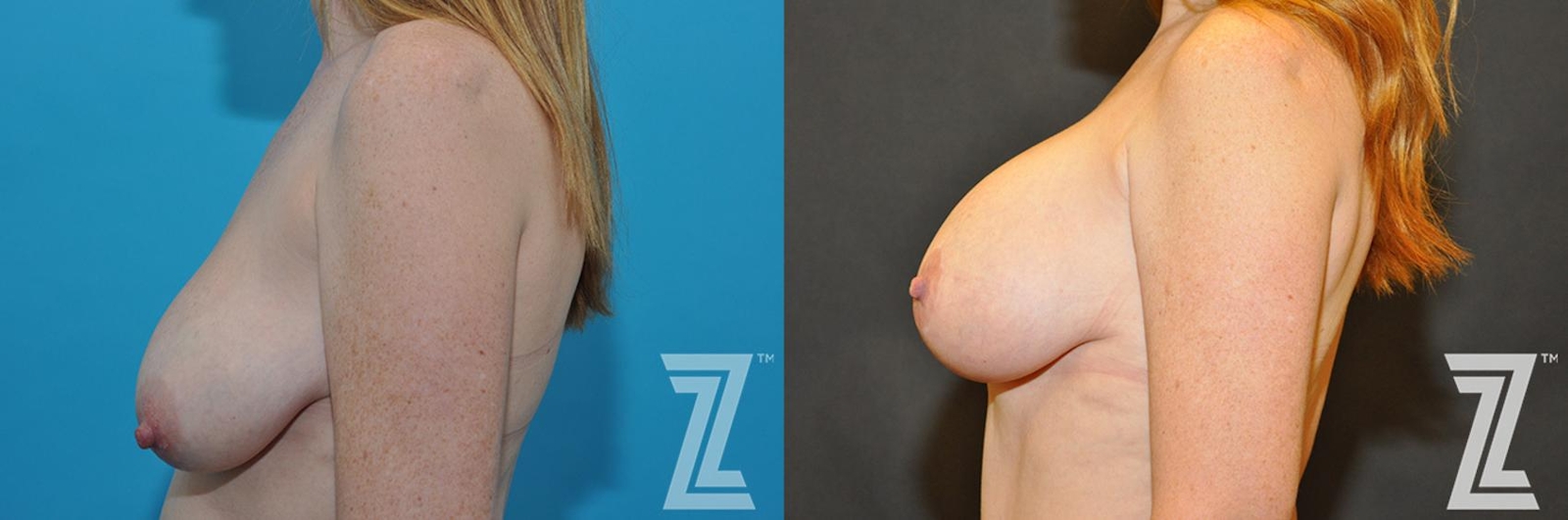 Austin Correction of Breast Asymmetry Before & After Gallery - Patient 132886778 - Image 3 - The Piazza Center