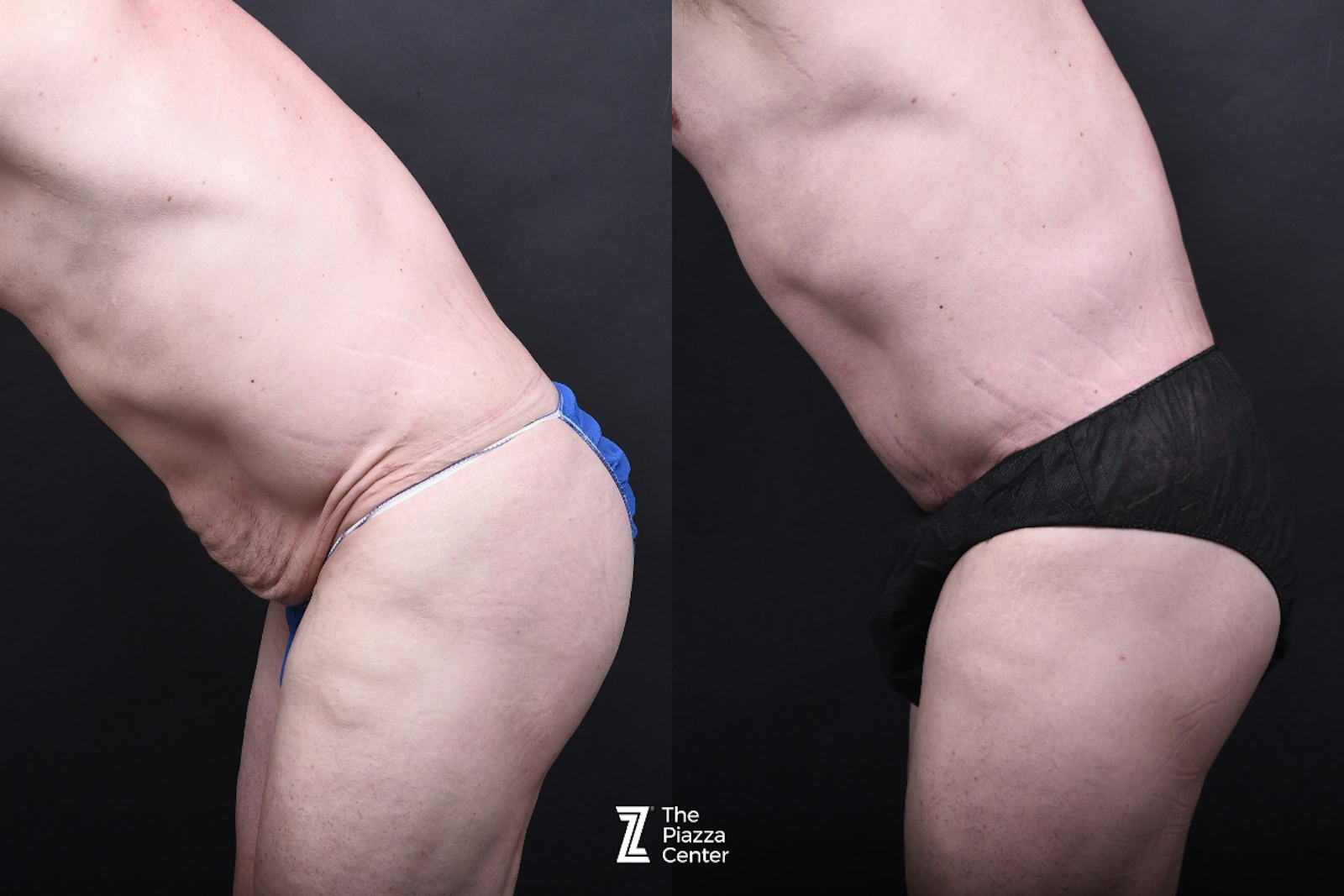 Austin Tummy Tuck Before & After Gallery - Patient 830228 - Image 5 - The Piazza Center