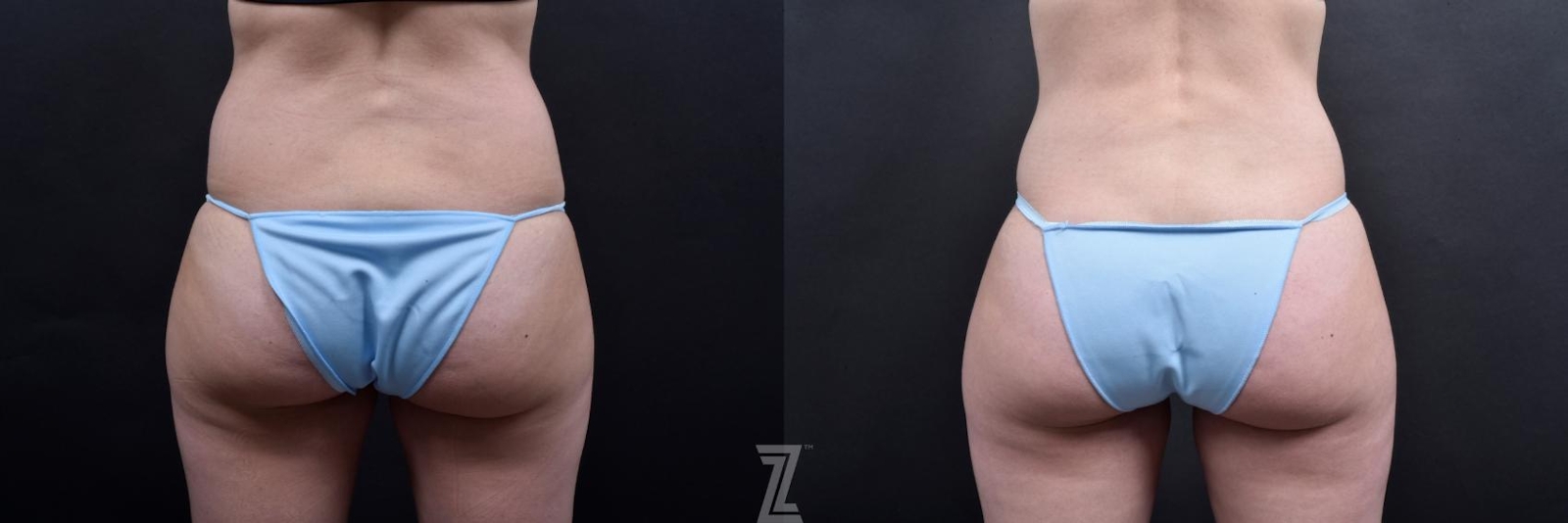 Austin Tummy Tuck Before & After Gallery - Patient 132886793 - Image 6 - The Piazza Center