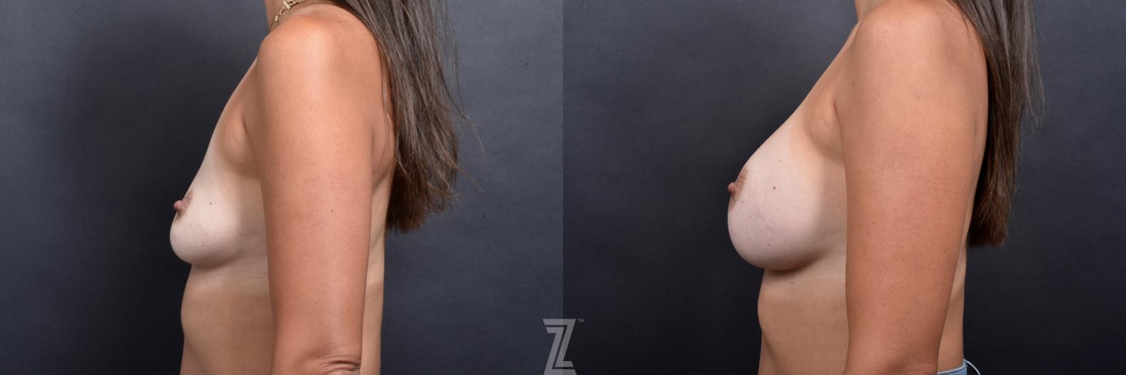Austin Lateral Before & after View of 37 year old woman with Silicone Implants with Cohesive Silicone Gel at the Piazza center - The Piazza Center