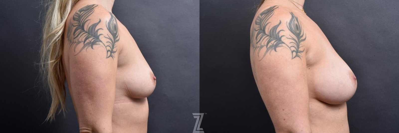 Austin Lateral 6 month post op before and after image of 39 year old woman with Silicone Implants with Cohesive Silicone Gel - The Piazza Center