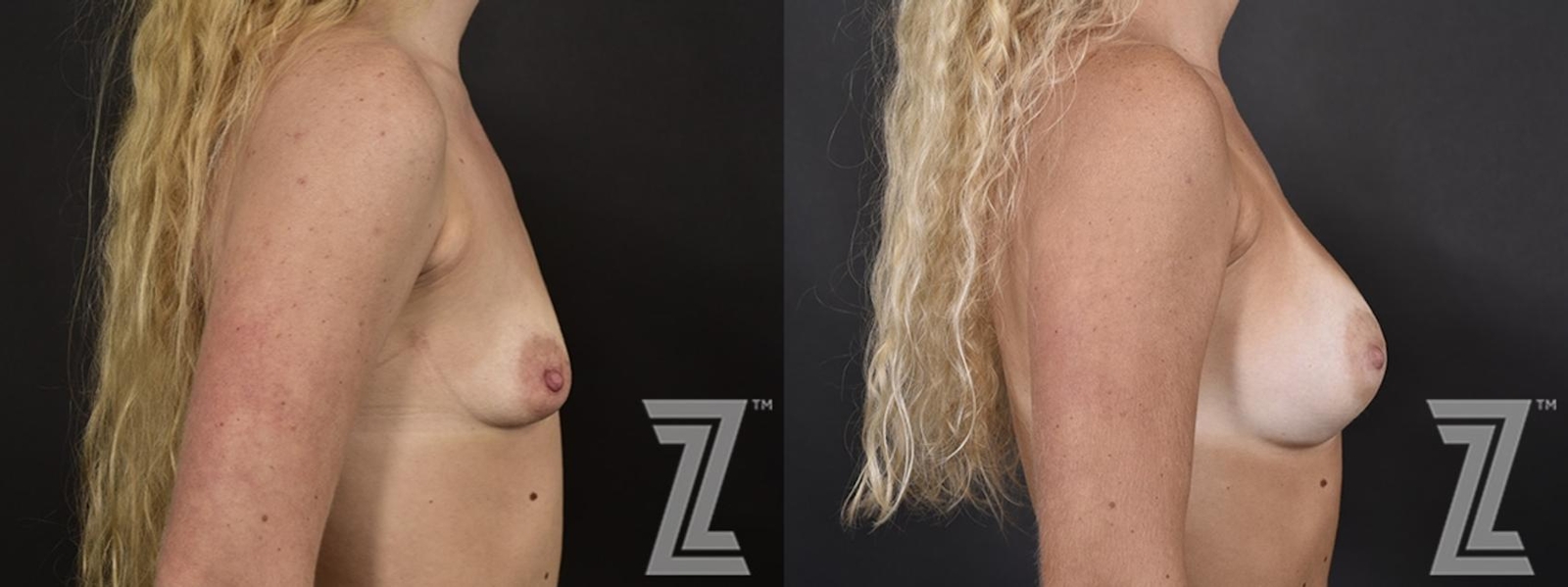 Austin lateral view of before and after image of 23 year old woman with Silicone Implants with Cohesive Silicone Gel at the piazza center - The Piazza Center