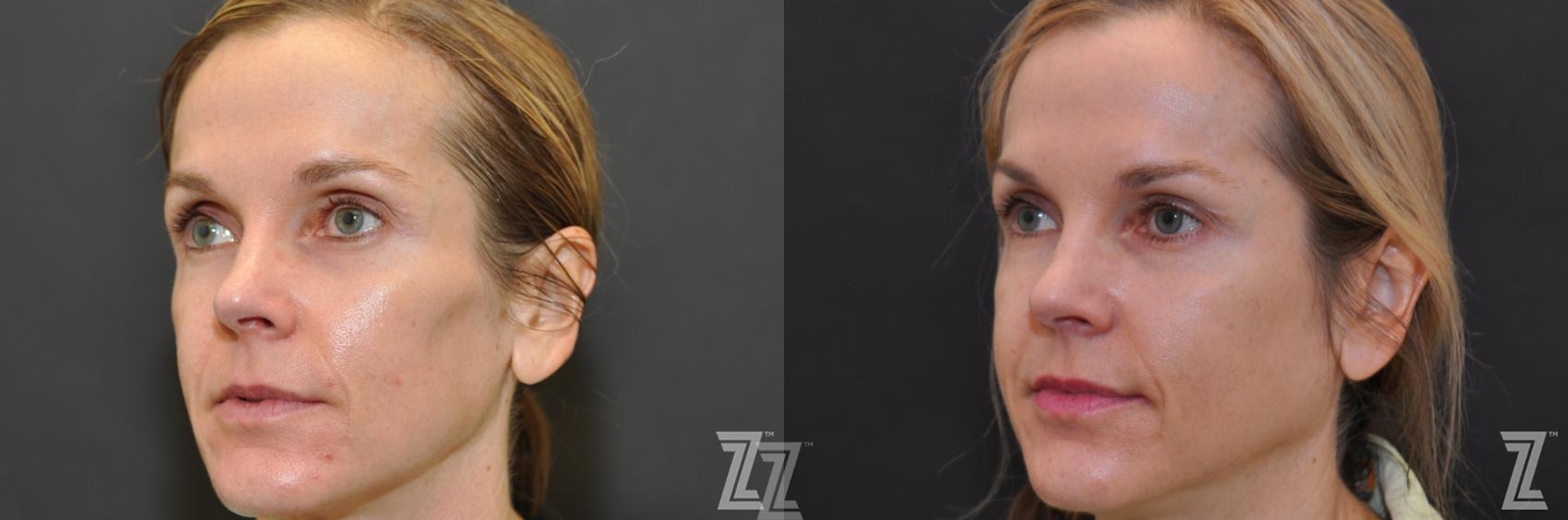 Austin Sculptra® Before & After Gallery - Patient 132963136 - Image 2 - The Piazza Center