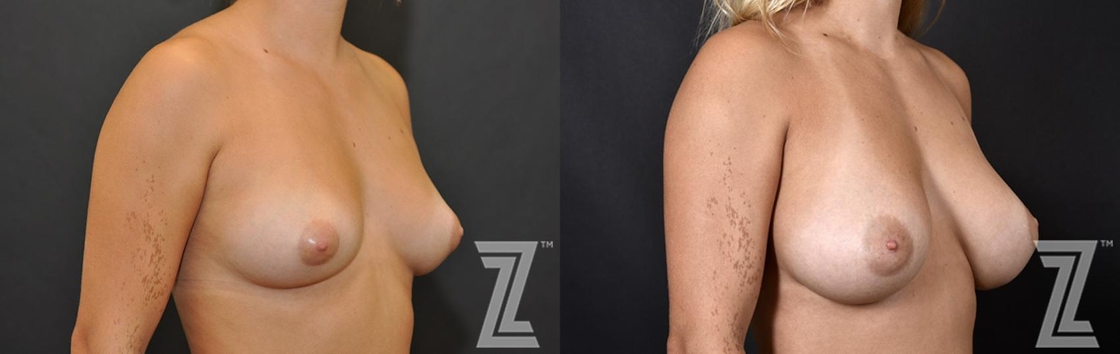 Austin Oblique view of before and after 2 year post op 23 year old woman with breast augmentation - The Piazza Center