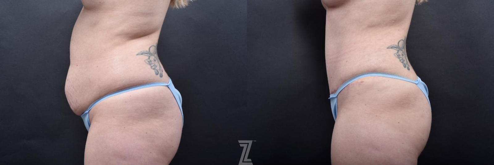 Austin 29-Year-Old Mommy Makeover Before & After by Dr. Rocco Piazza in Austin, Texas - Lateral View of Abdomen - The Piazza Center