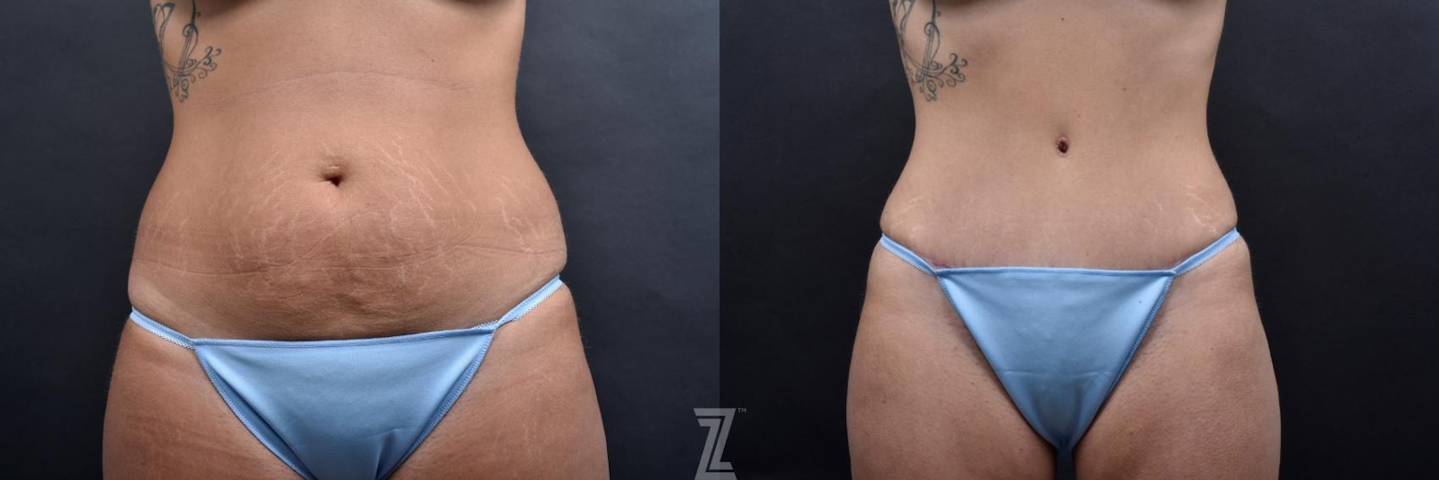 Austin Tummy Tuck Before & After Gallery - Patient 132886801 - Image 1 - The Piazza Center