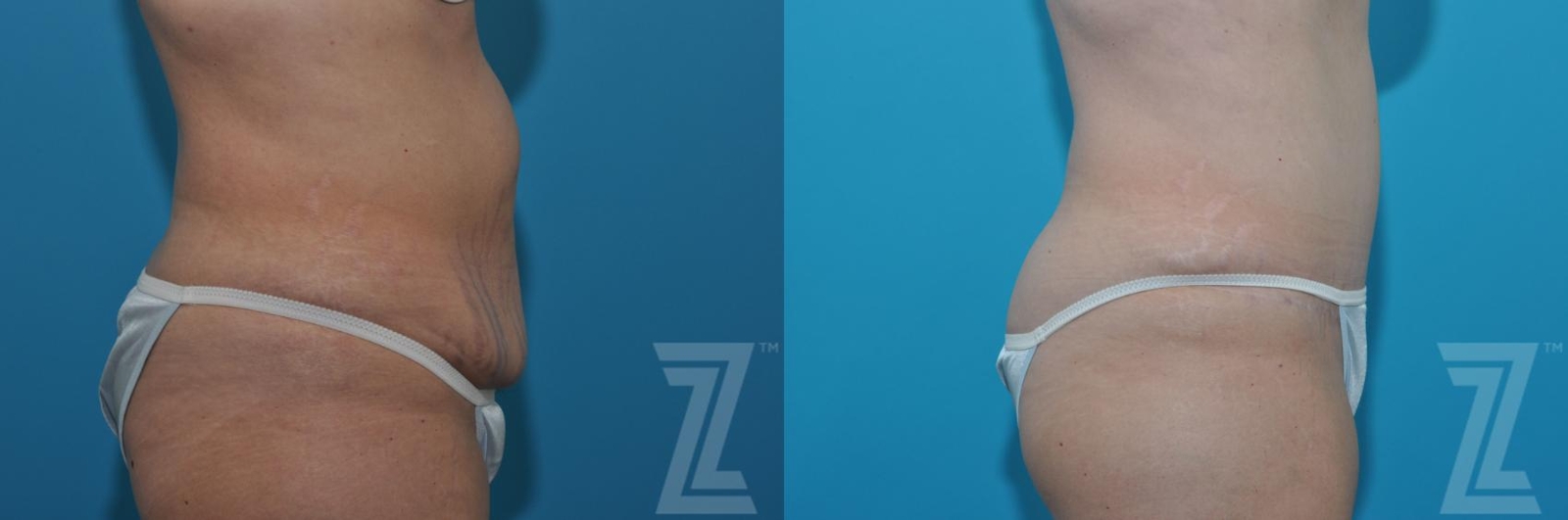 Austin Tummy Tuck Before & After Gallery - Patient 132886869 - Image 4 - The Piazza Center
