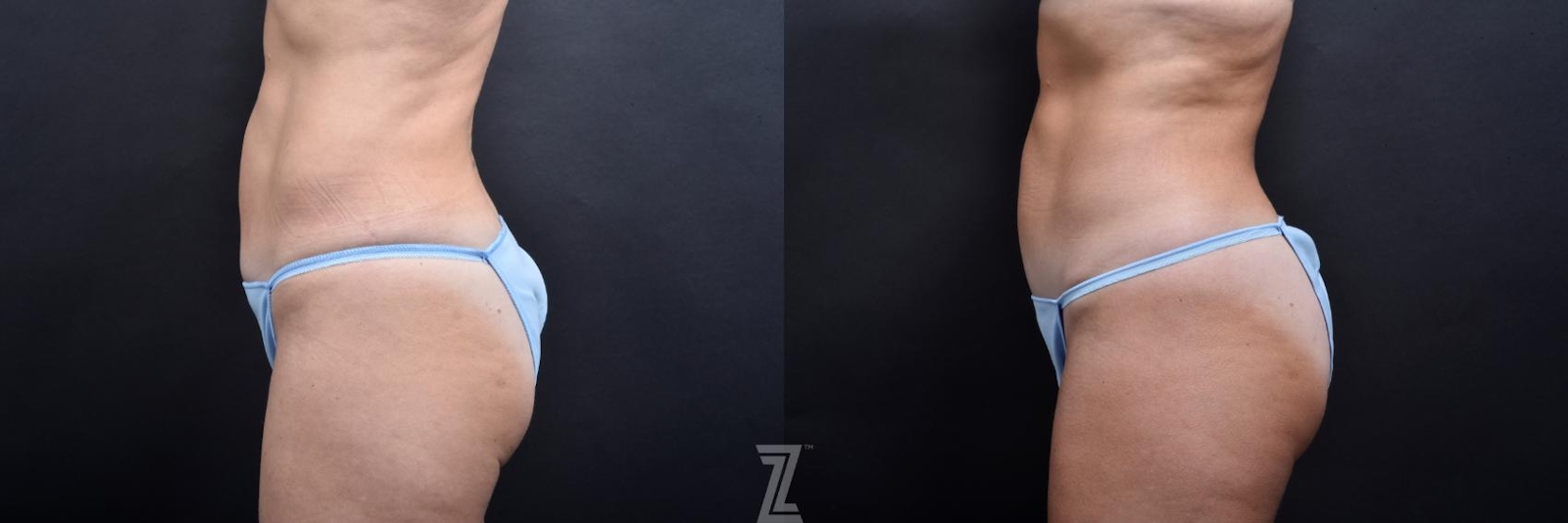 Austin Skin Pinch Before & After Gallery - Patient 132886939 - Image 2 - The Piazza Center