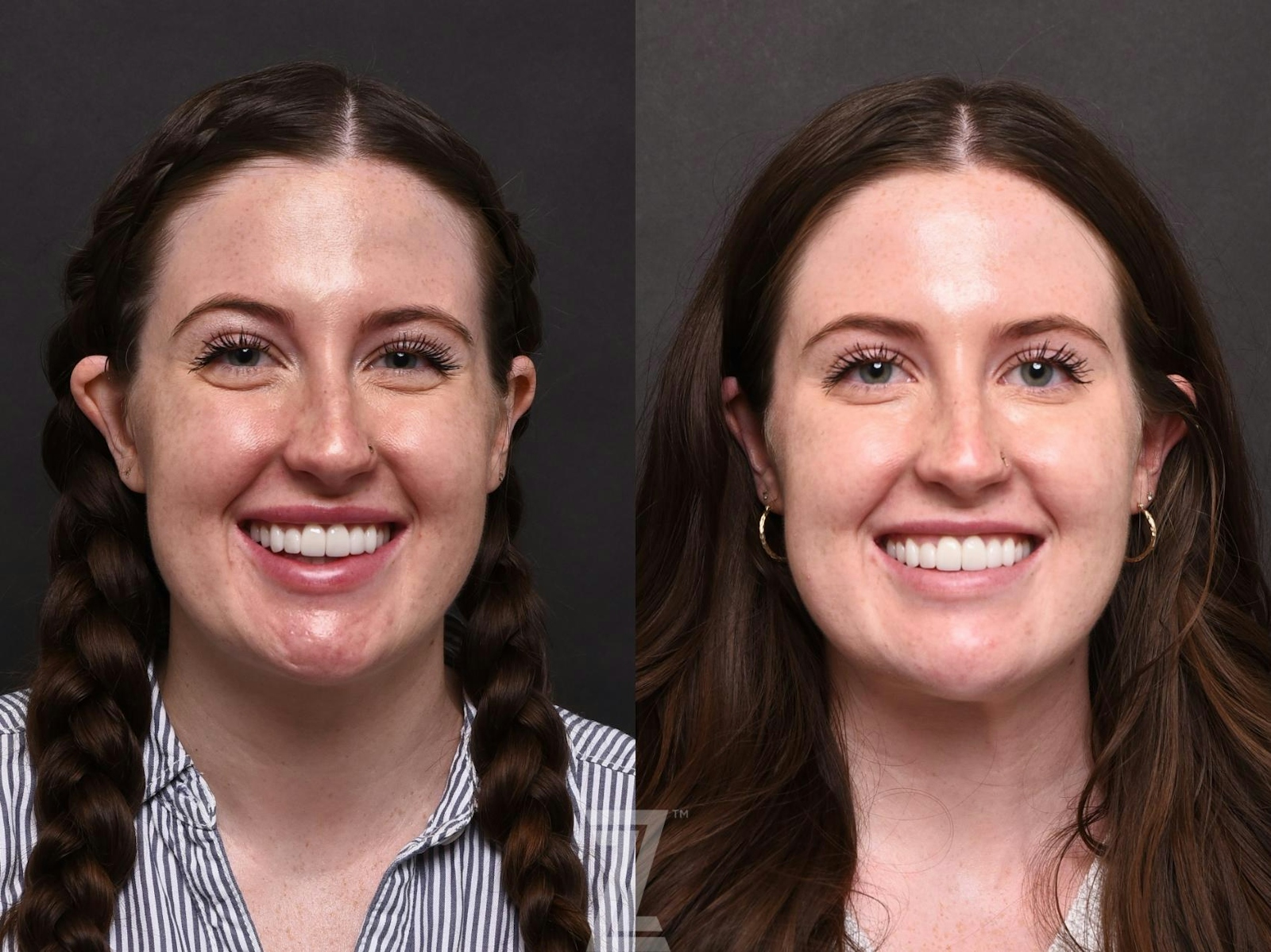 Austin Wrinkle Relaxers Before & After Gallery - Patient 132906322 - Image 1 - The Piazza Center