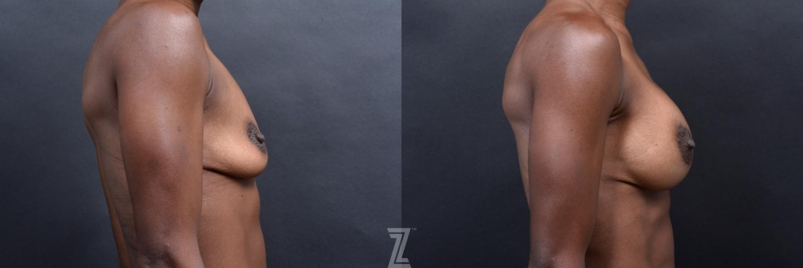 Austin Lateral before and after view of 33 year old athletic mom of two children breast augmentation - The Piazza Center