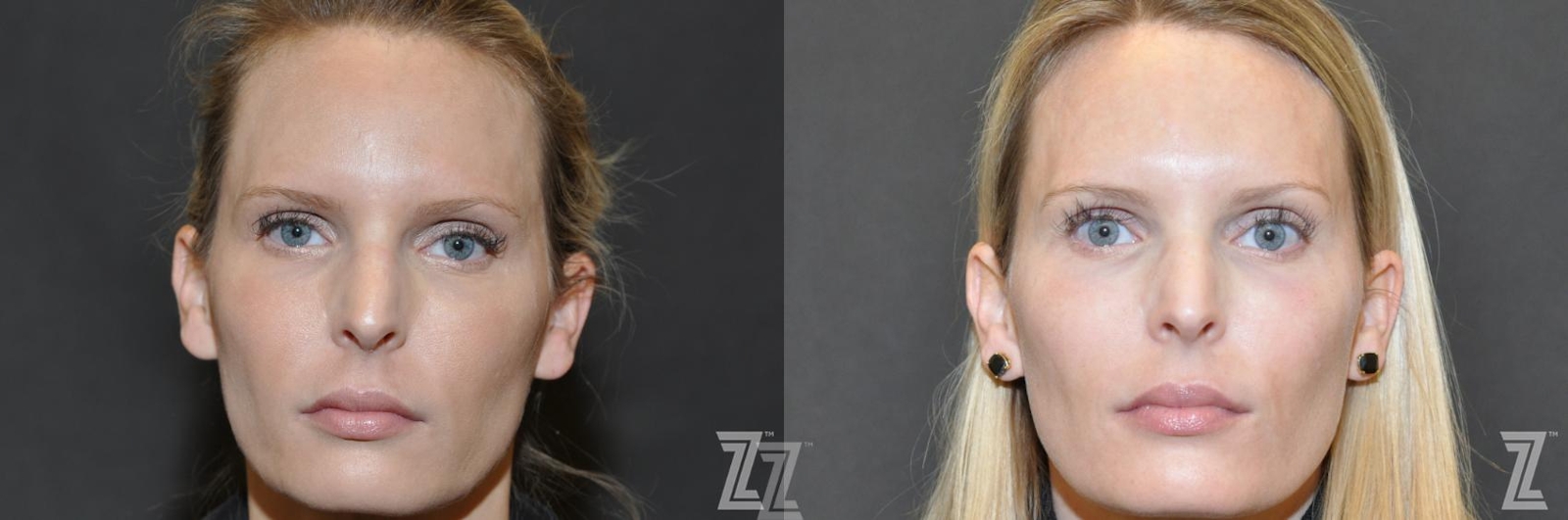 Austin Sculptra® Before & After Gallery - Patient 132963134 - Image 2 - The Piazza Center