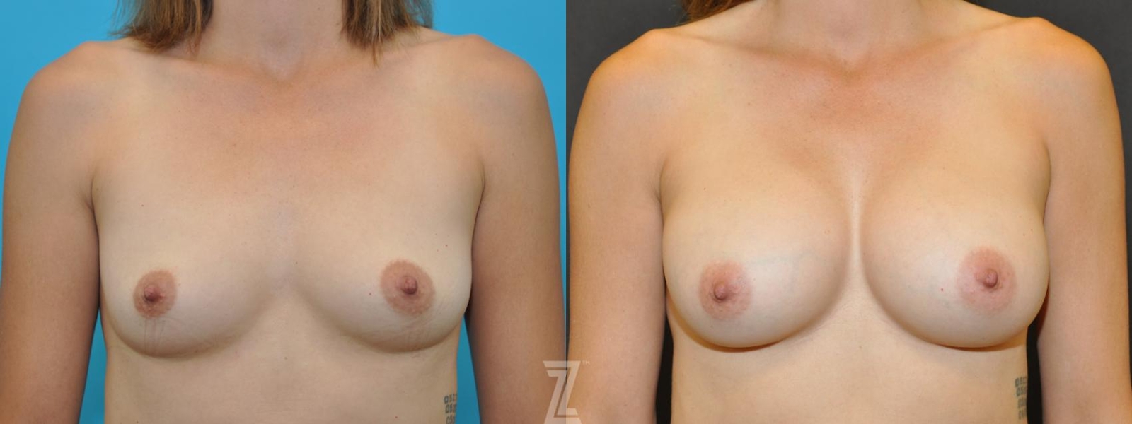 Austin Frontal view before & after images of 38-year-old active mother of three with Silicone Implants with Highly Cohesive Gel (Gummy Bear Implants) - The Piazza Center - The Piazza Center