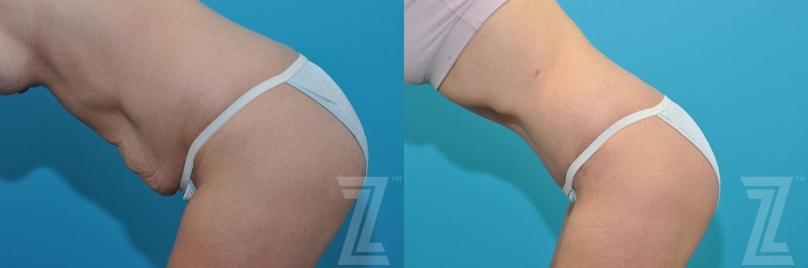 Austin Tummy Tuck Before & After Gallery - Patient 132886905 - Image 3 - The Piazza Center