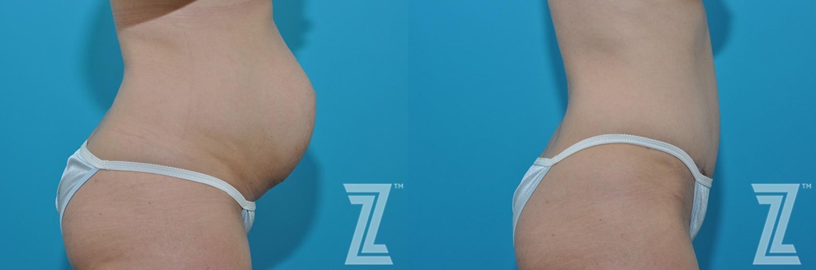 Austin Lateral abdominal view before & after 3 month post op 39 year old woman mommy make over - The Piazza Center, Austin TX - The Piazza Center