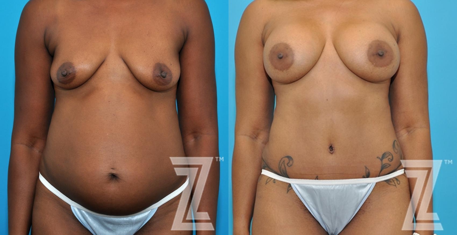 Austin Frontal Abdomen view of 43-year-old mother of two mommy maker over - Dr. Rocco Piazza - The Piazza Center
