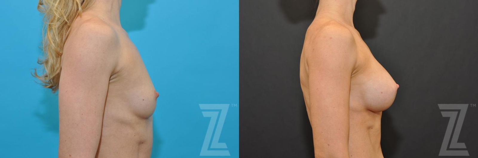 Austin Side View before and after of 36 year old woman with Silicone Implants with Highly Cohesive Gel (Gummy Bear Implants) - The Piazza Center - The Piazza Center