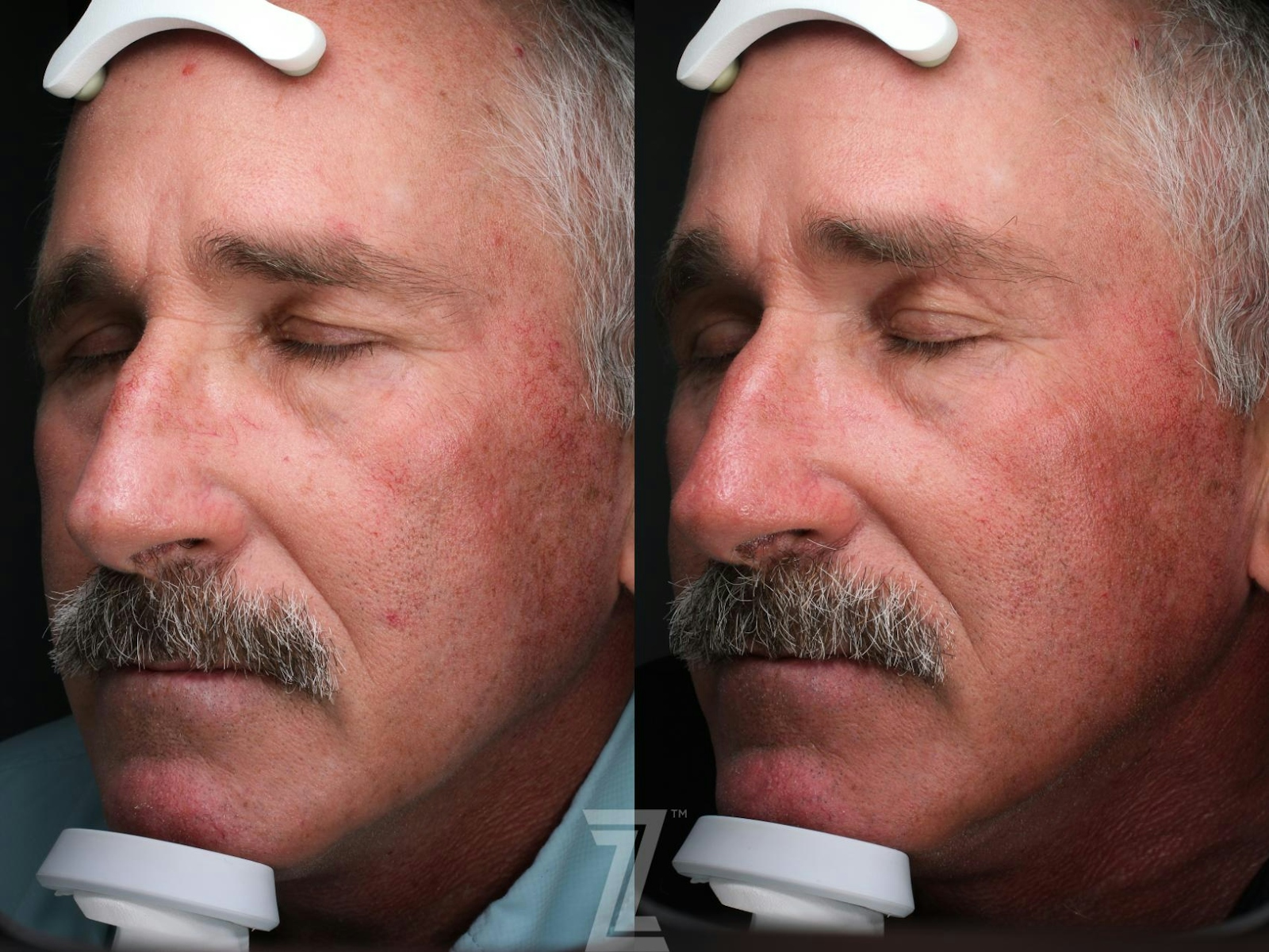 Austin Male Injectables Before & After Gallery - Patient 416183 - Image 1 - The Piazza Center