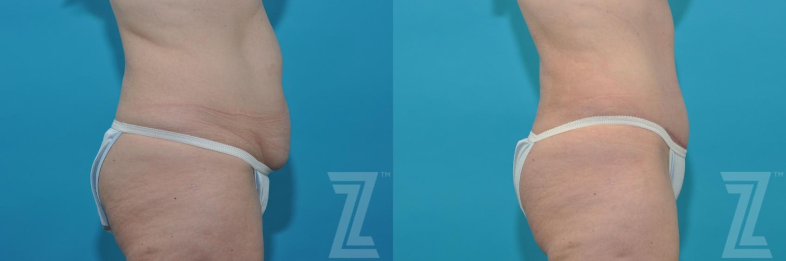 Austin Tummy Tuck Before & After Gallery - Patient 132886874 - Image 5 - The Piazza Center