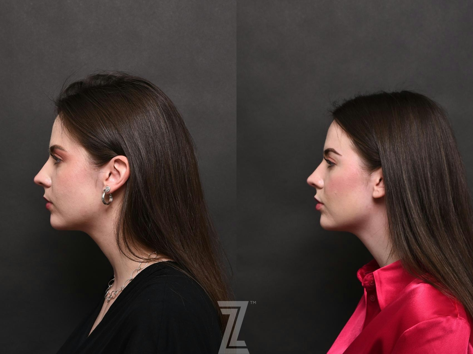 Austin Injectable Fillers Before & After Gallery - Patient 132963119 - Image 2 - The Piazza Center