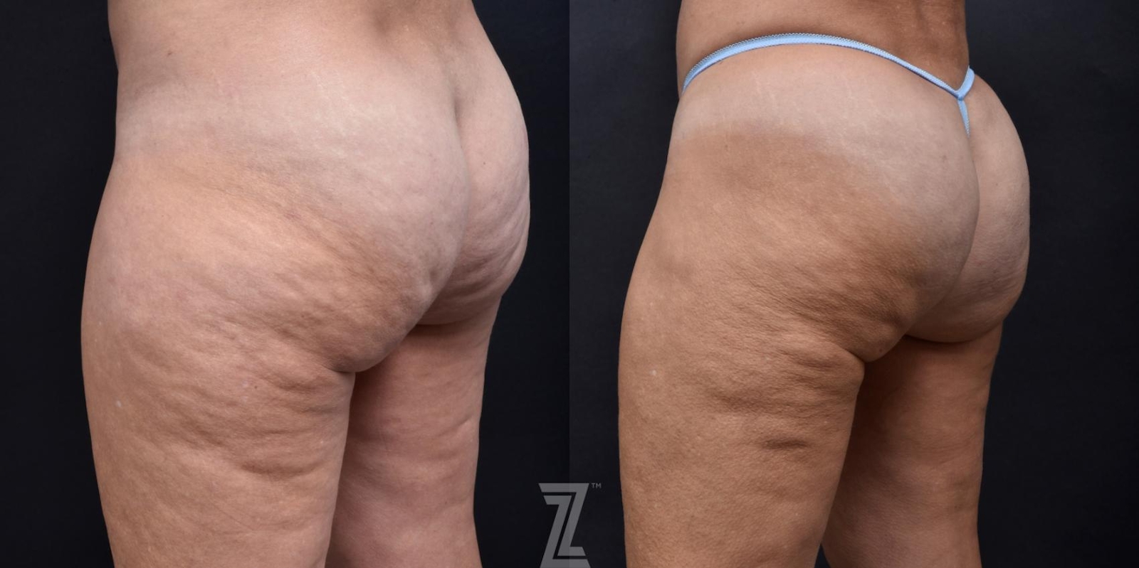 Austin Avéli Before & After Gallery - Patient 132905402 - Image 2 - The Piazza Center