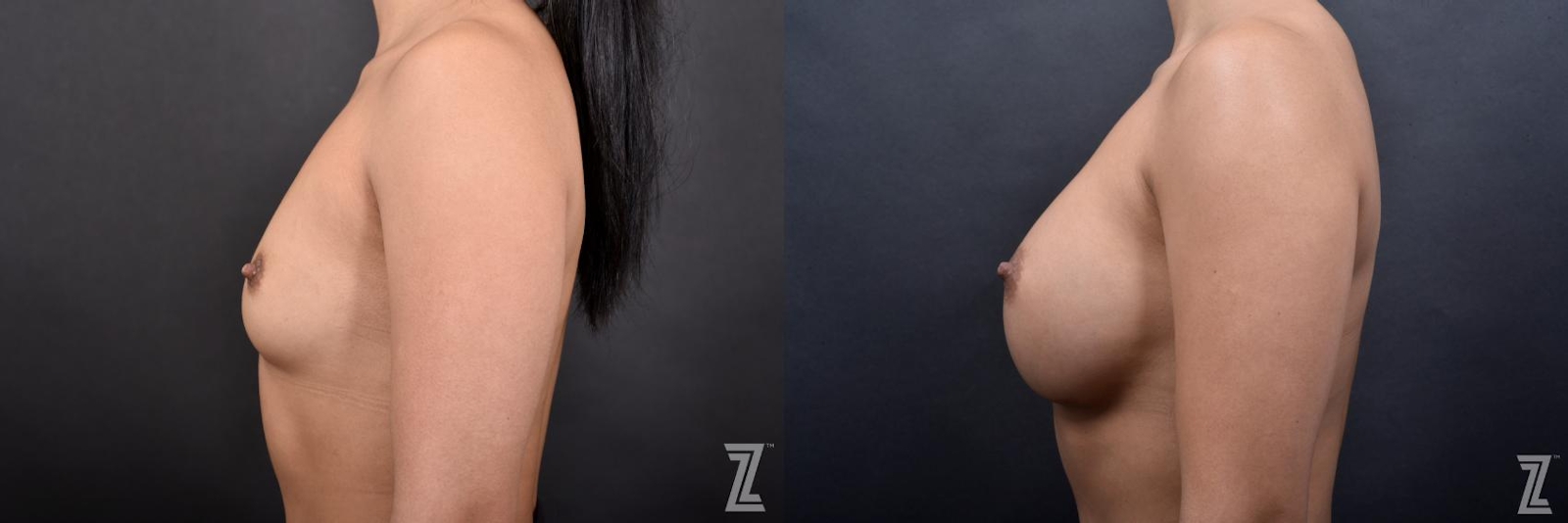 Austin Lateral View Before & After Breast Augmentation of 25-Year-Old Female Patient at The Piazza Center in Austin - Dr. Piazza - The Piazza Center