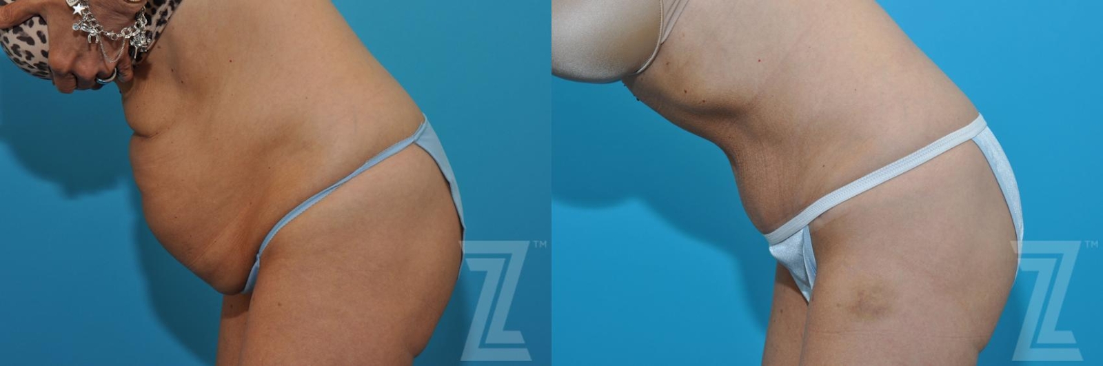 Austin Tummy Tuck Before & After Gallery - Patient 132886871 - Image 3 - The Piazza Center