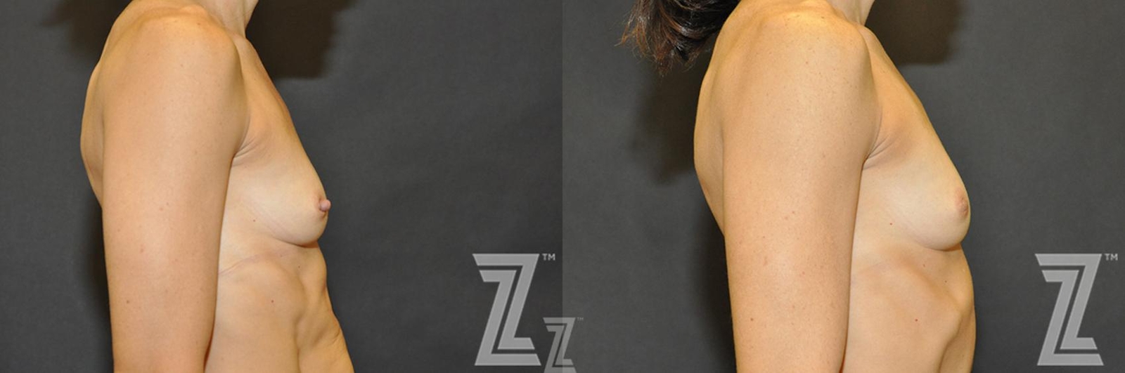 Austin Nipple Reduction Before & After Gallery - Patient 132886785 - Image 4 - The Piazza Center