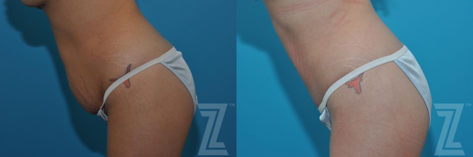 Austin Tummy Tuck Before & After Gallery - Patient 132886879 - Image 3 - The Piazza Center