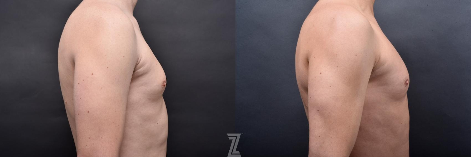 Austin Male Body Contouring Before & After Gallery - Patient 273342 - Image 8 - The Piazza Center