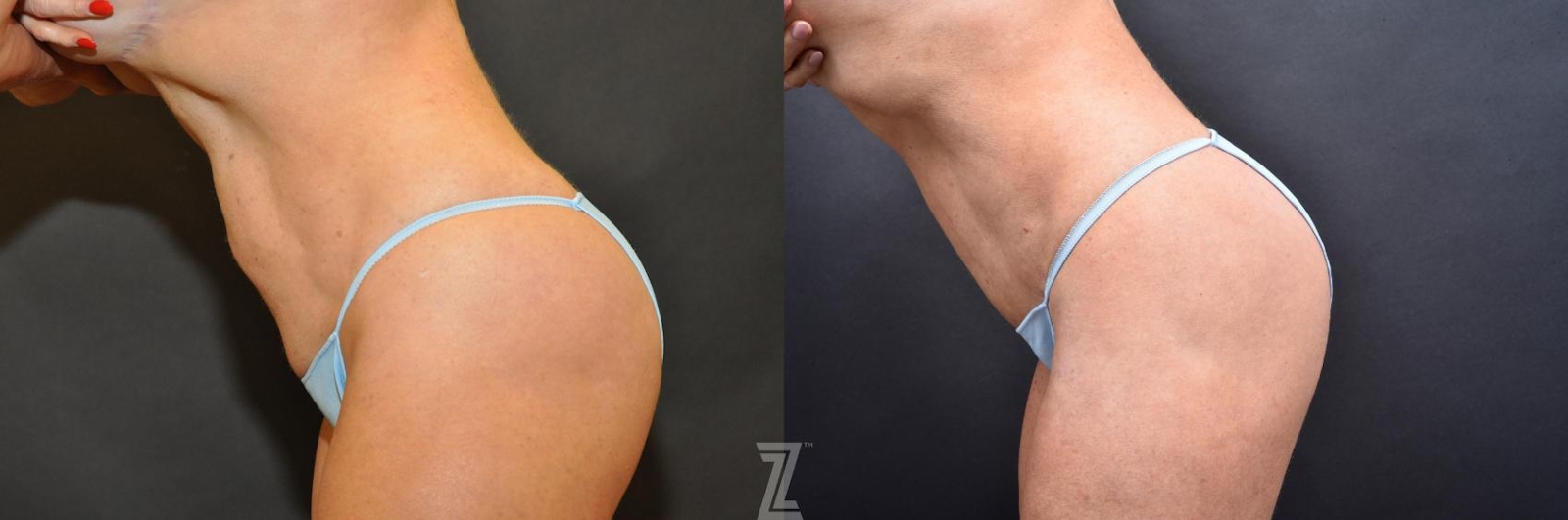 Austin Skin Pinch Before & After Gallery - Patient 132886906 - Image 3 - The Piazza Center