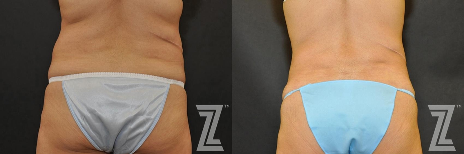 Austin Tummy Tuck Before & After Gallery - Patient 132886902 - Image 4 - The Piazza Center