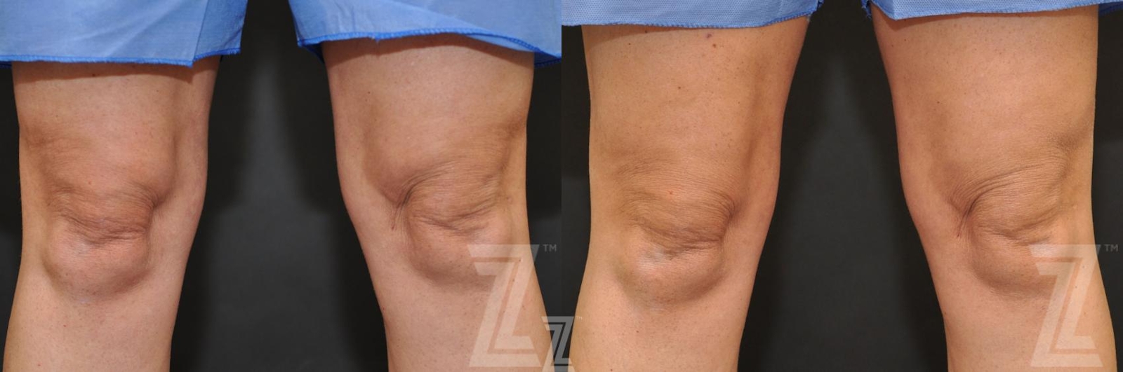 Austin CoolSculpting® Before & After Gallery - Patient 132905392 - Image 1 - The Piazza Center