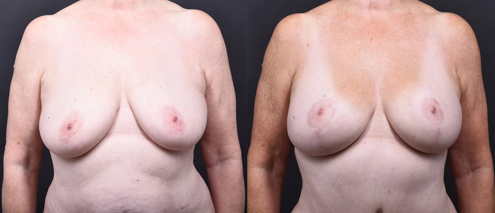 Austin Breast Augmentation With a Breast Lift Before & After Gallery - Patient 438571 - Image 1 - The Piazza Center