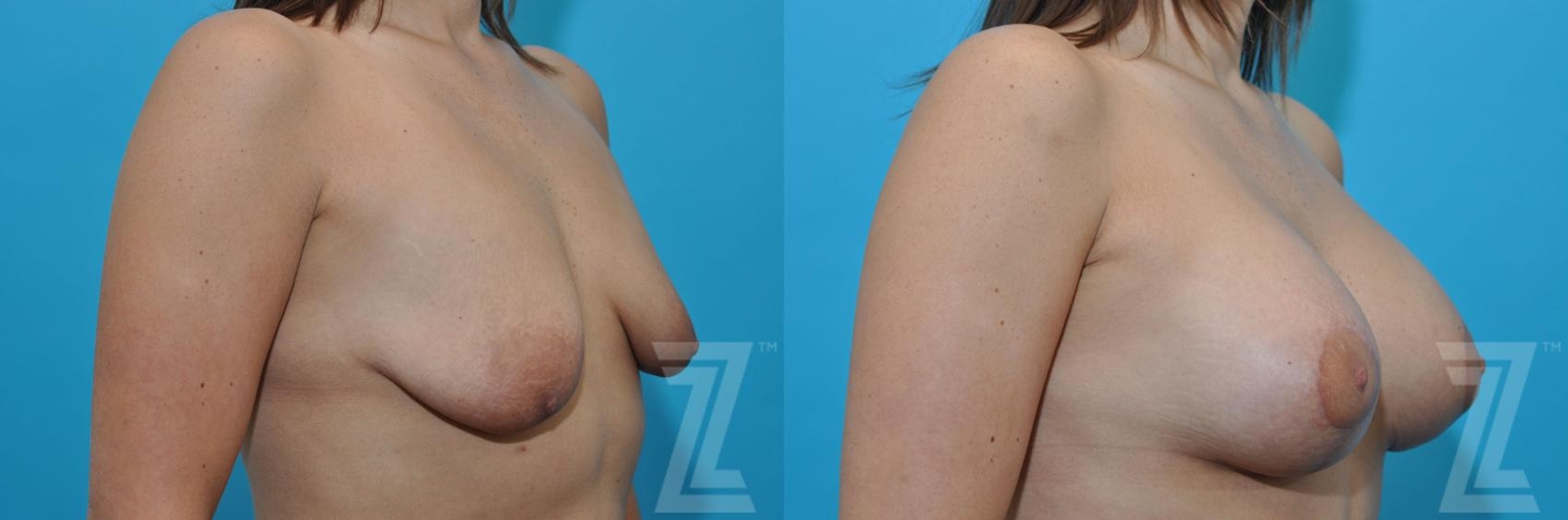 Austin Breast Augmentation With a Breast Lift Before & After Gallery - Patient 132791109 - Image 5 - The Piazza Center