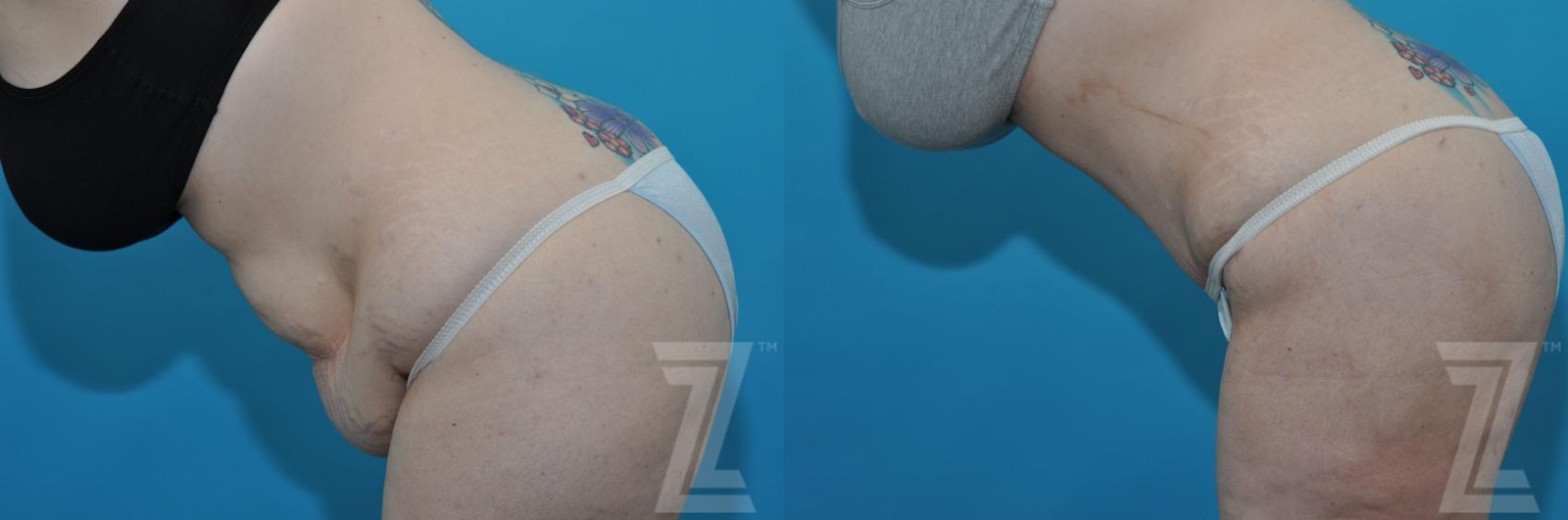 Austin Tummy Tuck Before & After Gallery - Patient 132886824 - Image 3 - The Piazza Center