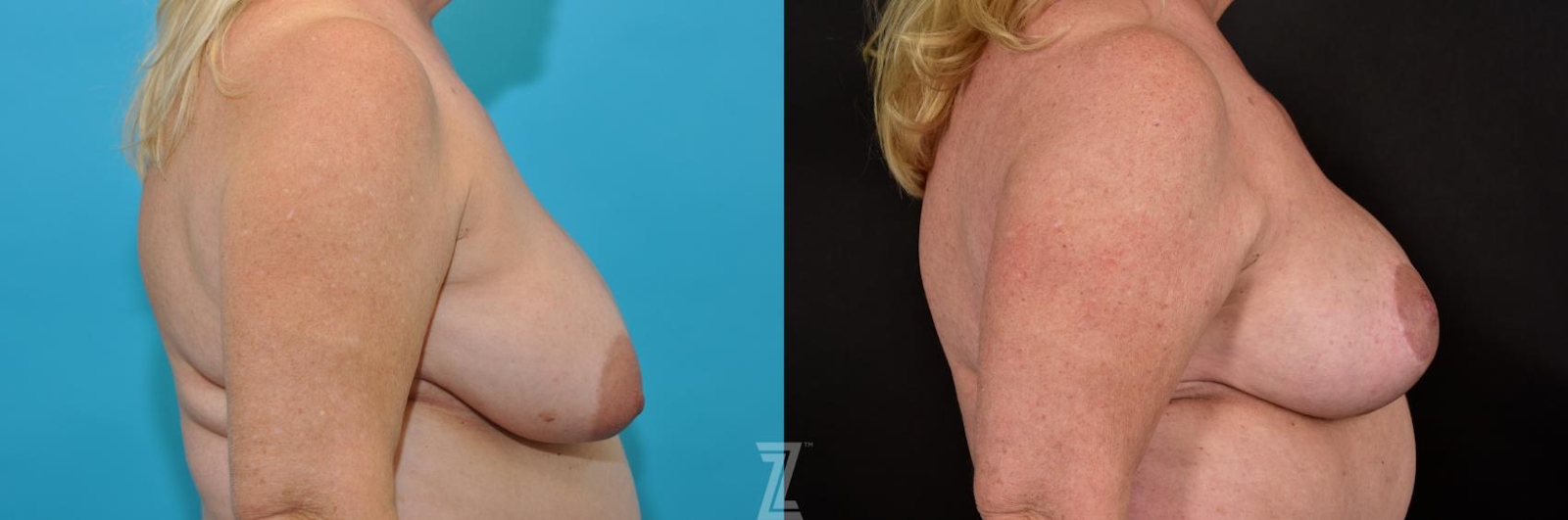 Austin Breast Lift Before & After Gallery - Patient 132791071 - Image 5 - The Piazza Center