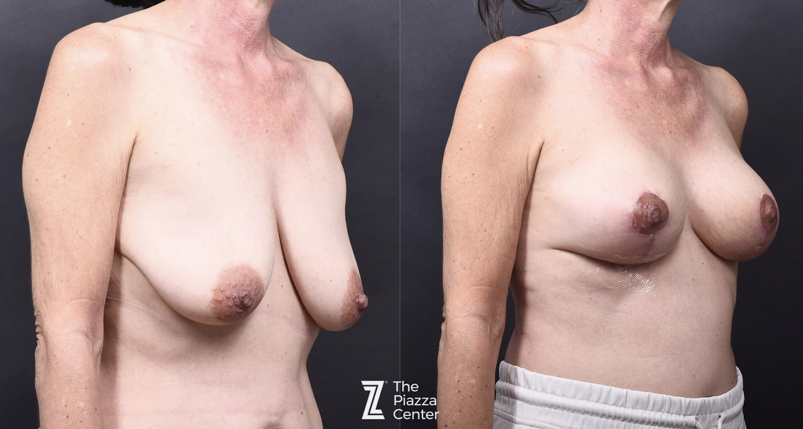 Austin Breast Augmentation With a Breast Lift - The Piazza Center