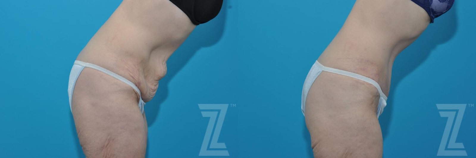 Austin Tummy Tuck Before & After Gallery - Patient 132886817 - Image 5 - The Piazza Center