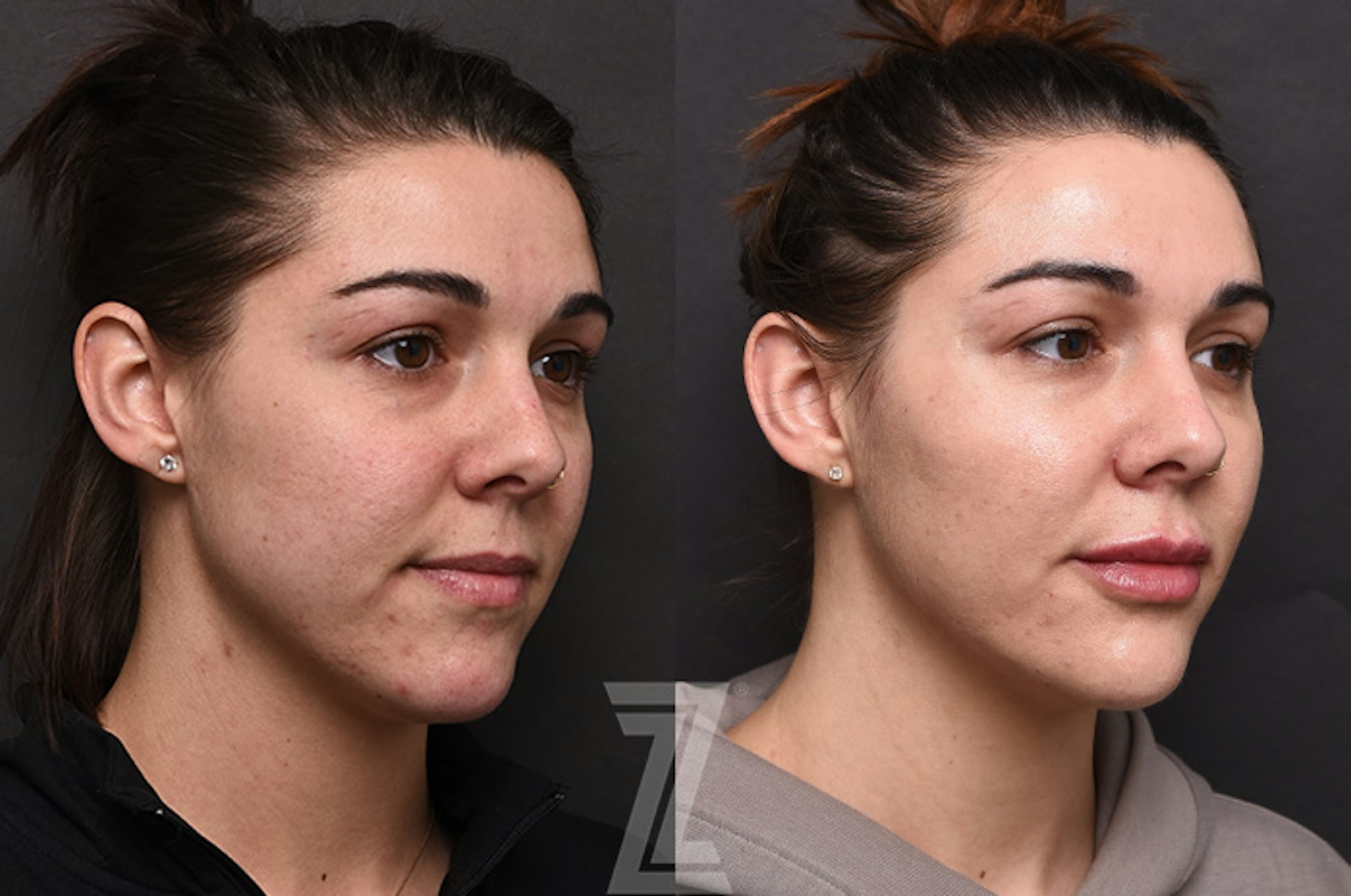 Austin Facial Rejuvenation Before & After Gallery - Patient 238339 - Image 2 - The Piazza Center