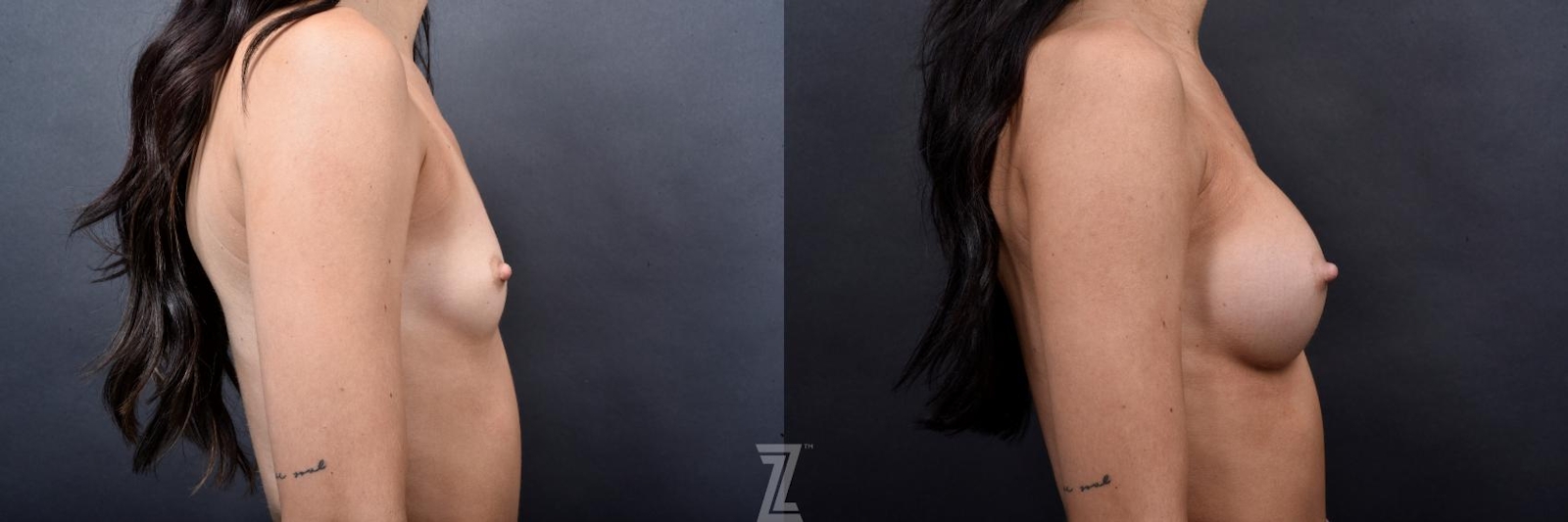 Austin Lateral view of 24 year old woman 6 month post op with Silicone Implants with Cohesive Silicone Gel - Dr. Rocco Piazza - The Piazza Center