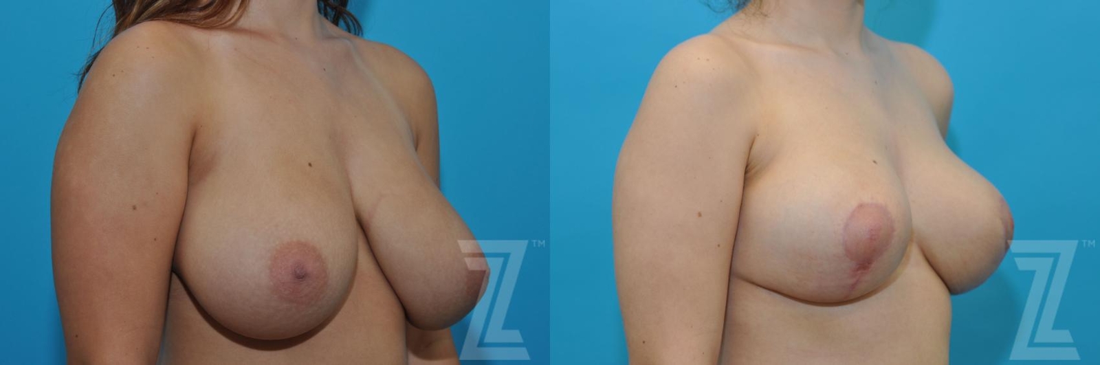 Austin Breast Reduction Before & After Gallery - Patient 132886608 - Image 4 - The Piazza Center