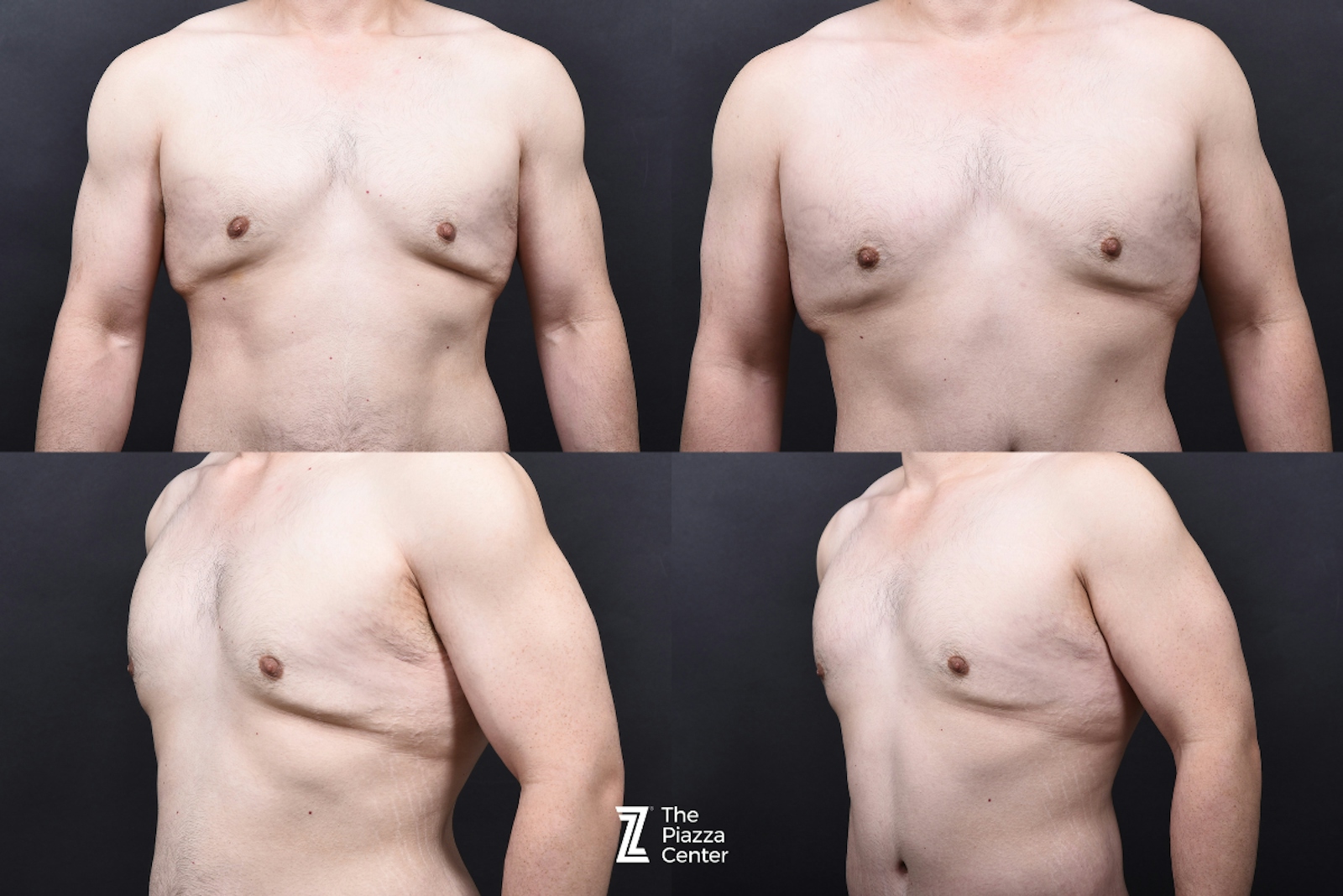 Austin Tummy Tuck Before & After Gallery - Patient 346471 - Image 9 - The Piazza Center