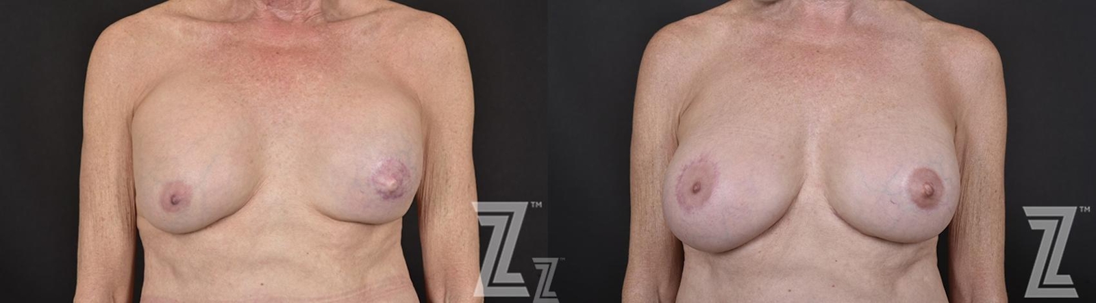Austin Breast Reconstruction Before & After Gallery - Patient 132886765 - Image 1 - The Piazza Center