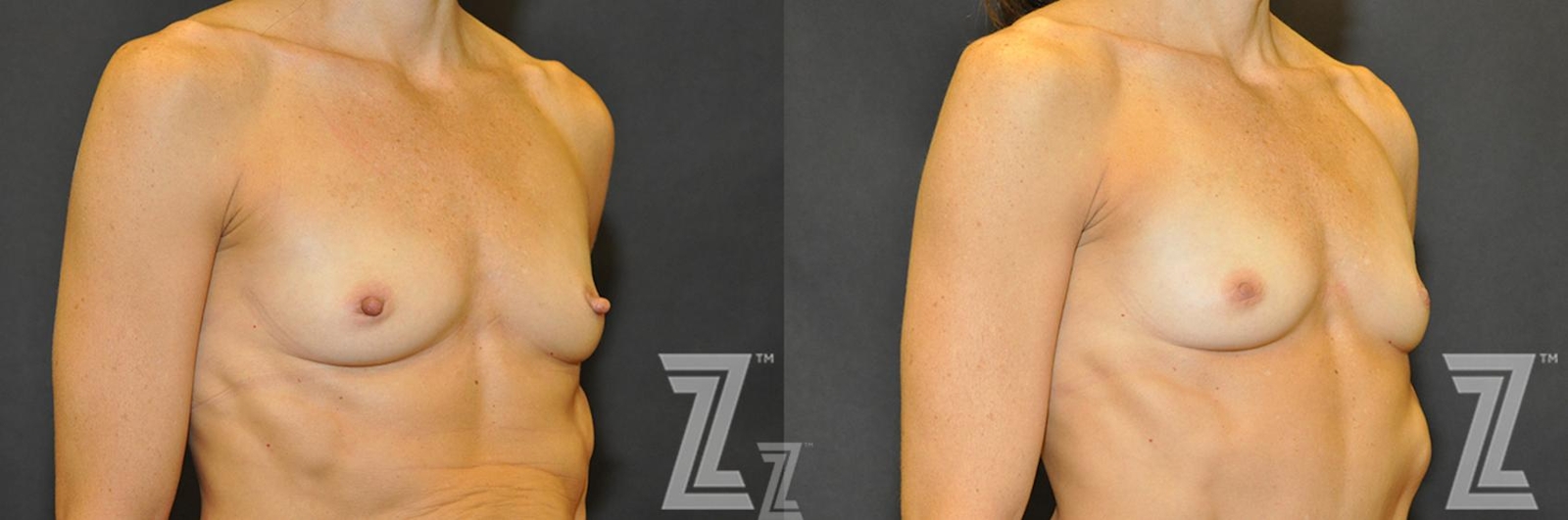 Austin Nipple Reduction Before & After Gallery - Patient 132886785 - Image 2 - The Piazza Center