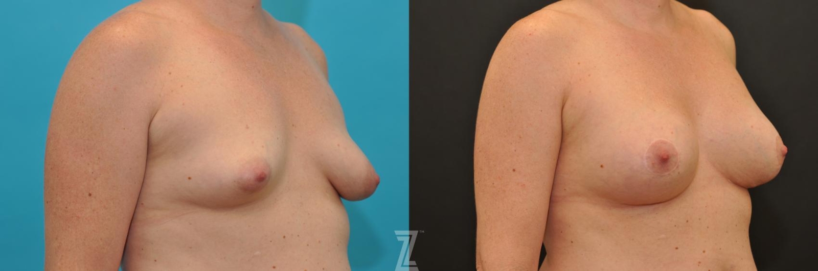 Austin Breast Augmentation With a Breast Lift Before & After Gallery - Patient 132791097 - Image 4 - The Piazza Center