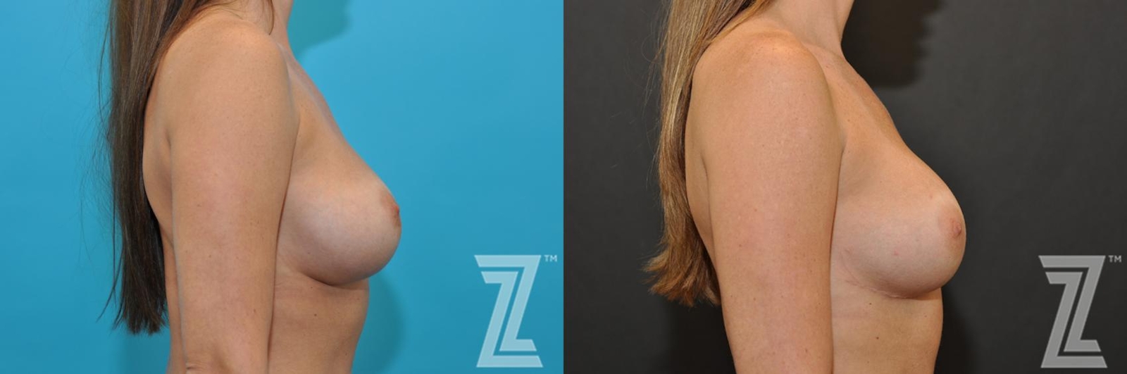 Austin Breast Augmentation Revision Before & After Gallery - Patient 132886561 - Image 5 - The Piazza Center