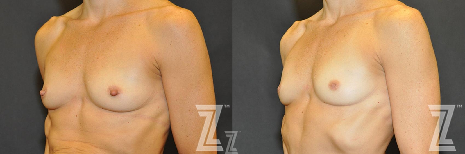 Austin Nipple Reduction Before & After Gallery - Patient 132886785 - Image 1 - The Piazza Center