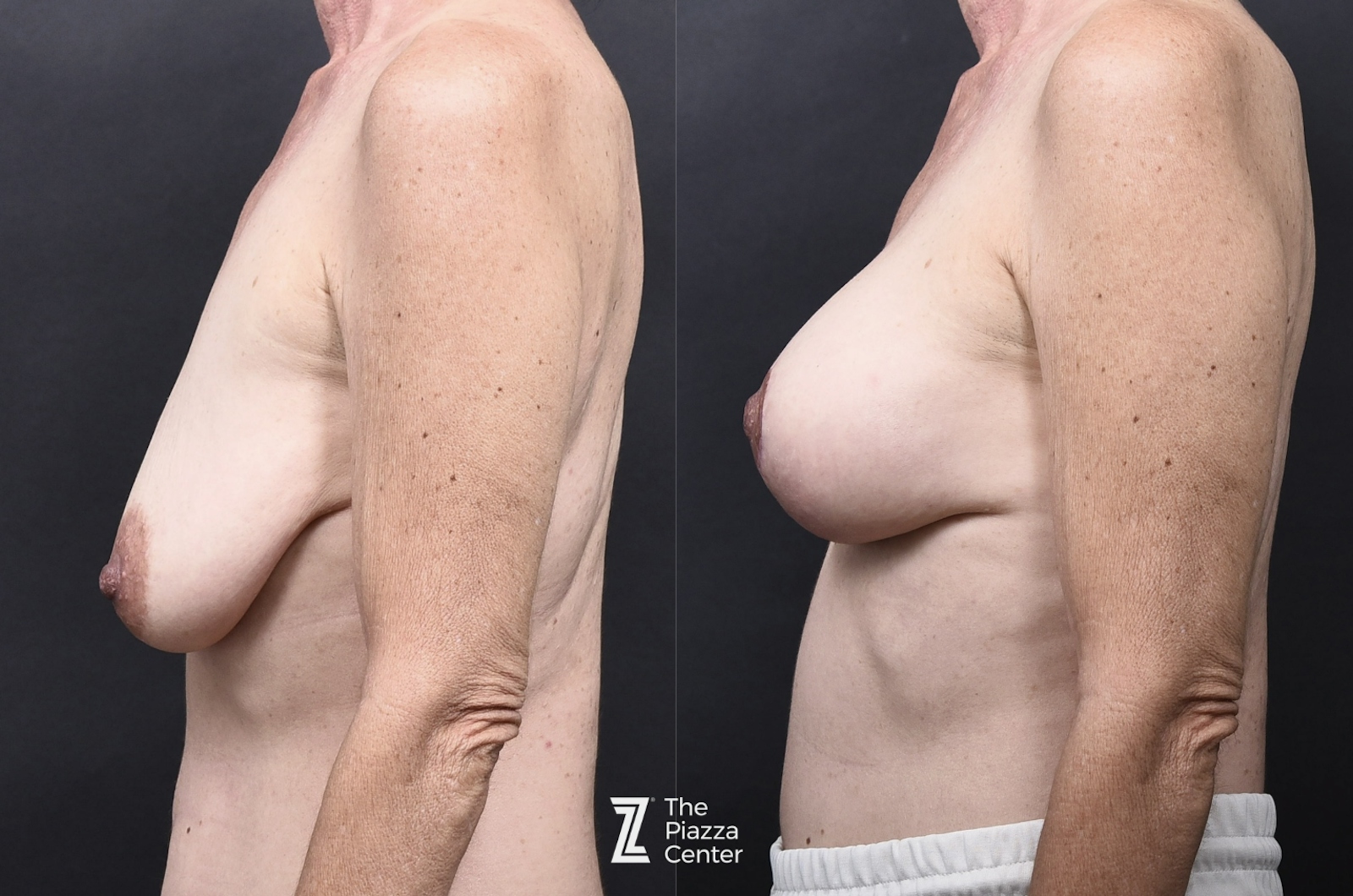 Austin Breast Augmentation With a Breast Lift Side View - The Piazza Center