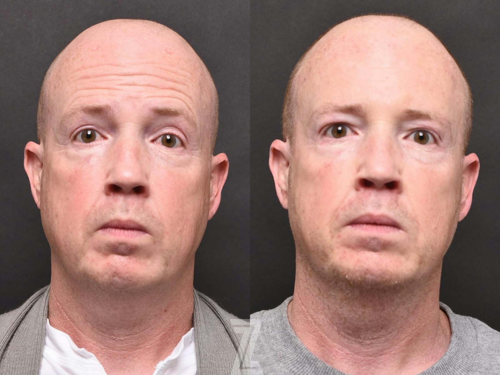 Austin Wrinkle Relaxers Before & After Gallery - Patient 132906313 - Image 1 - The Piazza Center